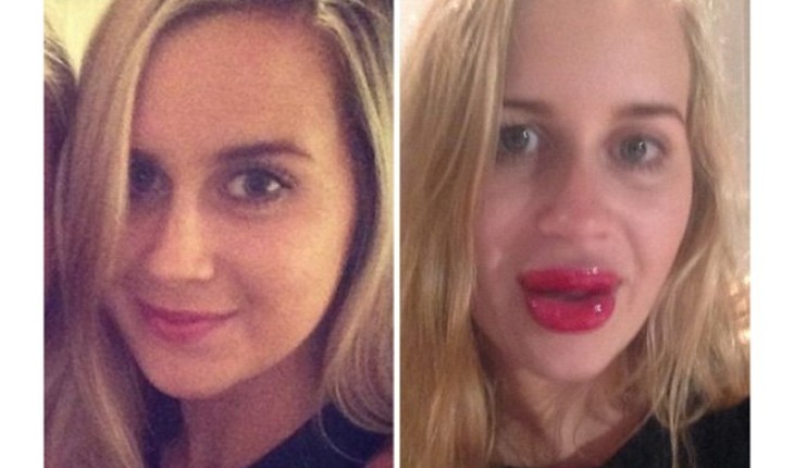 Страх і жах: дівчата до і після збільшення губ (ФОТО)